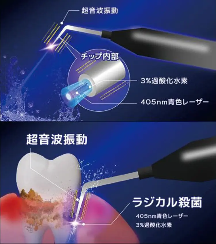ブルーラジカルによる治療、超音波振動と405mm青色レーザーによる治療