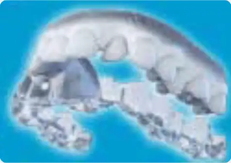 インビザライン矯正